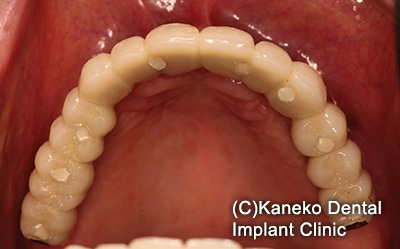 症例5 オール・オン・フォー (インプラント8本) 58歳, 女性