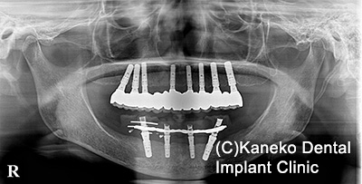 症例5 オール・オン・フォー (インプラント8本) 58歳, 女性