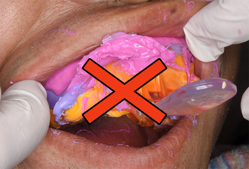 口腔内スキャナーの９つの利点