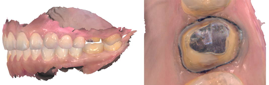 口腔内スキャナーの3つの欠点