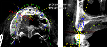 1）インプラント治療へのCTの利用