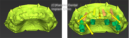 1）インプラント治療へのCTの利用