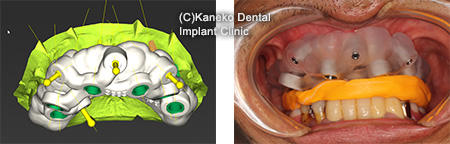 1）インプラント治療へのCTの利用