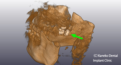 2）親知らずの抜歯へのCTの利用