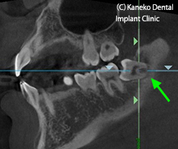 2）親知らずの抜歯へのCTの利用