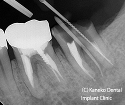 デンタルX線では原因となっている根光が不明