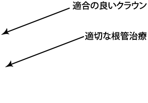 適合の良いクラウン / 適切な根管治療