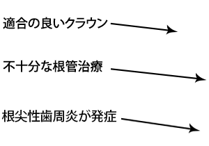 適合の良いクラウン / 不十分な根管治療 / 根尖性歯周炎が発症