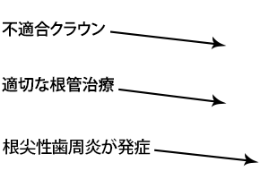 不適合クラウン / 適切な根管治療 / 根尖性歯周炎が発祥 