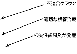 不適合クラウン / 適切な根管治療