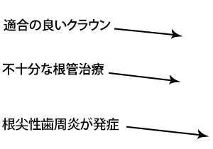 適合の良いクラウン / 不十分な根管治療