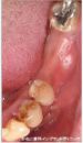 症例1　下顎前歯部症例