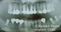 インプラント埋入後のパノラマＸ線写真