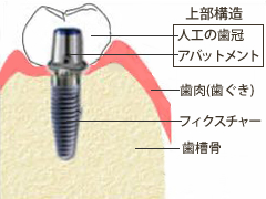 アバットメント接続の進化1（垂直的な接続様式の進化）