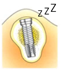 2.  スリープ中（機能させていない）のインプラントは除外した方がよい。Sleeping implants, preferably not be included.