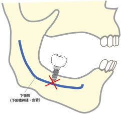 3.上顎洞や鼻腔、下歯槽神経への穿孔は失敗とは考えない。Perforation of sinus, nasal cavity or mandibular nerve canal are not considered failures.