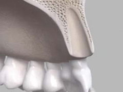 難易度の高い前歯のインプラント手術