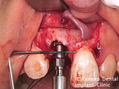 垂直的インプラントの埋入位置