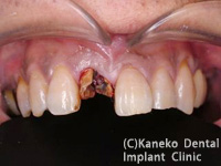 前歯部のインプラント症例1（抜歯即時インプラント埋入）