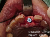 前歯部のインプラント症例1（抜歯即時インプラント埋入）
