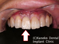 前歯部のインプラント症例1（抜歯即時インプラント埋入）