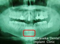 前歯部のインプラント症例1（抜歯即時インプラント埋入）