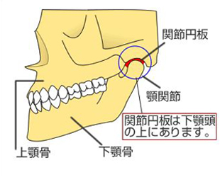 関節円板の前方転移