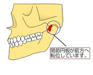 関節円板の前方転移