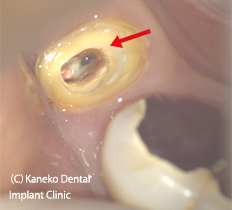 顕微鏡で観察し、未処置の舌側根管を発見した。（赤矢印）