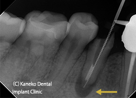 ファイルで舌側根管を穿通（黄矢印）