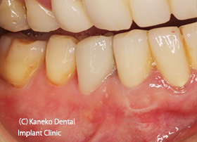 治癒した歯肉とクラウン